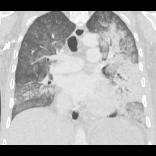 File:Acute diffuse alveolar hemorrhage (Radiopaedia 41323-44158 Coronal lung window 27).jpg