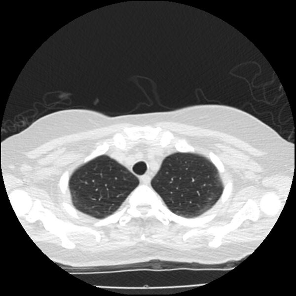 File:Acute interstitial pneumonitis (Radiopaedia 45404-49444 Axial lung window 16).jpg
