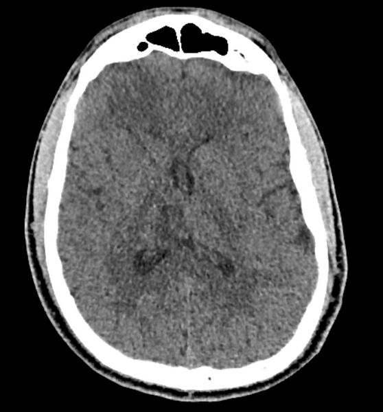 File:Acute ischemic stroke - posterior circulation territory (Radiopaedia 77670-89881 non-contrast 49).jpg