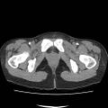 Acute myocarditis (Radiopaedia 55988-62613 Axial C+ portal venous phase 82).jpg