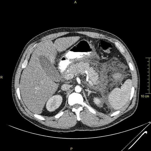 File:Acute pancreatitis (Radiopaedia 23231-23290 Axial C+ arterial phase 32).JPG