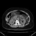 Acute pancreatitis - Balthazar C (Radiopaedia 26569-26714 Axial non-contrast 38).jpg