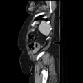 Acute pyelonephritis (Radiopaedia 25657-25837 Sagittal renal parenchymal phase 67).jpg