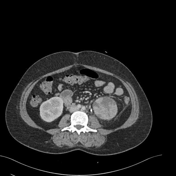 File:Acute pyelonephritis with renal vein thrombosis (Radiopaedia 58020-65053 Axial renal parenchymal phase 108).jpg