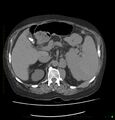 Acute renal failure post IV contrast injection- CT findings (Radiopaedia 47815-52557 Axial non-contrast 26).jpg