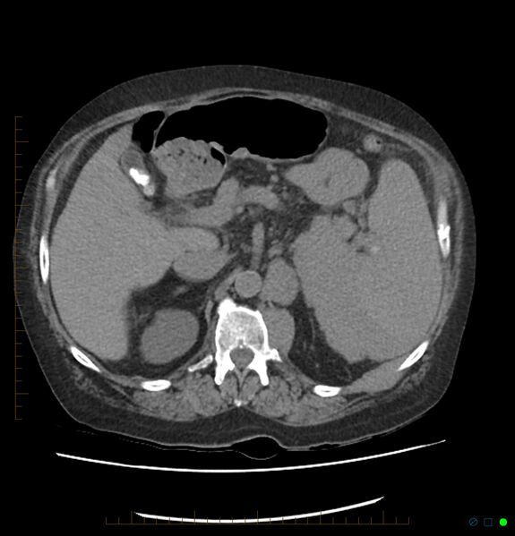 File:Acute renal failure post IV contrast injection- CT findings (Radiopaedia 47815-52557 Axial non-contrast 26).jpg
