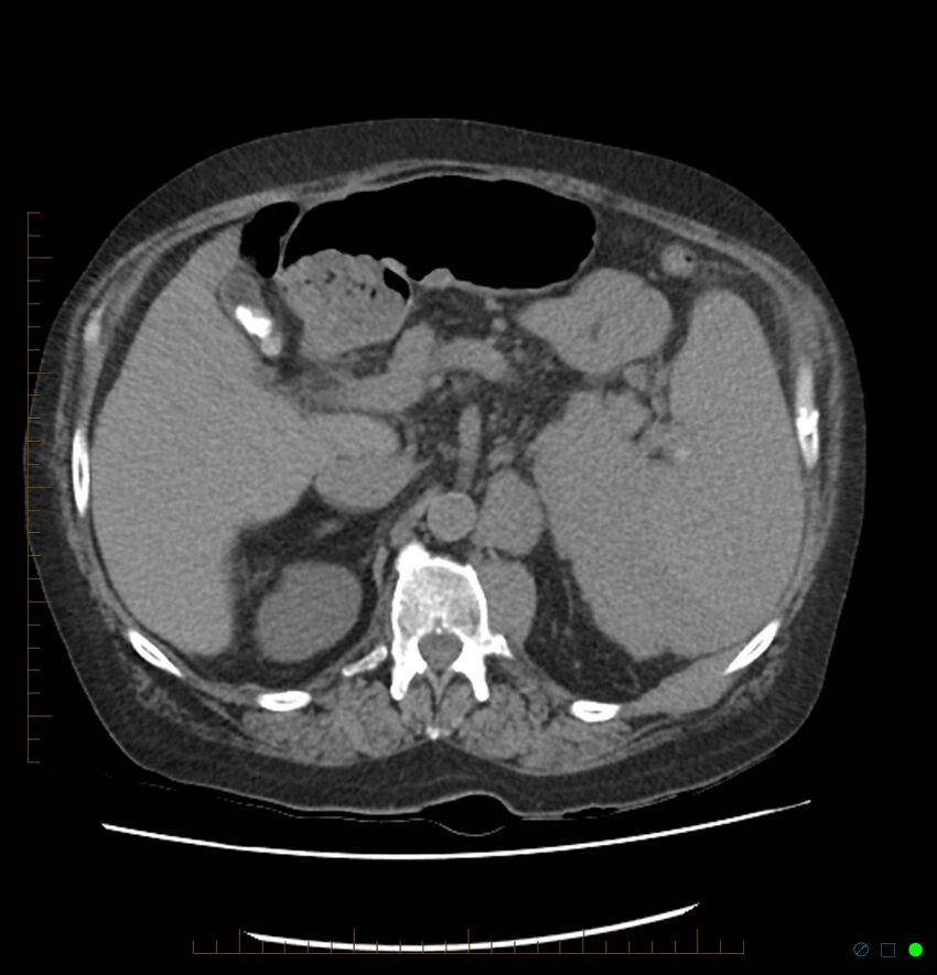 Acute renal failure post IV contrast injection- CT findings (Radiopaedia 47815-52557 Axial non-contrast 26).jpg