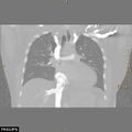 Acute reversible pulmonary hypertension and right heart failure from cocaine toxicity (Radiopaedia 49394-54517 Coronal C+ CTPA 21).jpg