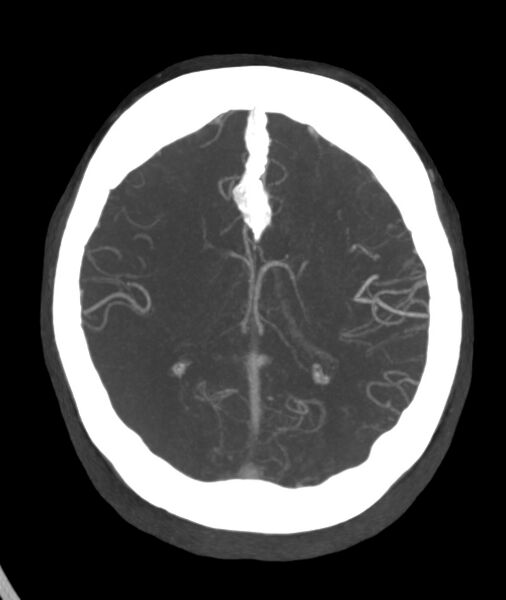 File:Acute right MCA M1 occlusion (Radiopaedia 62268-70454 Axial Phase 1 11).jpg