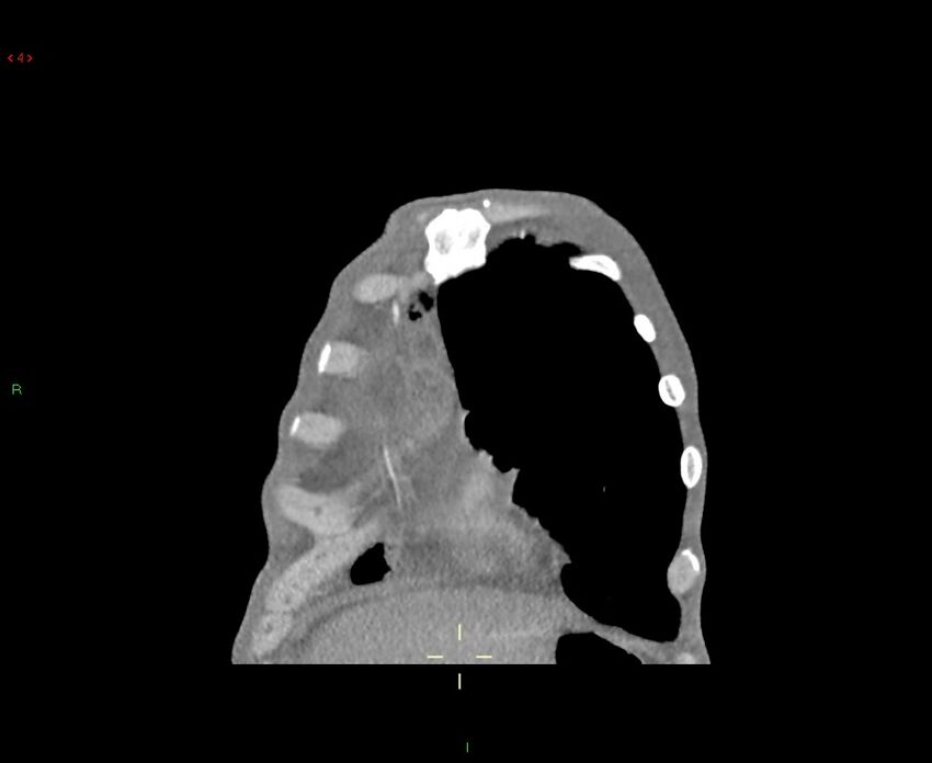 Acute right lung abscess (Radiopaedia 34806-36258 Coronal C+ arterial phase 51).jpg
