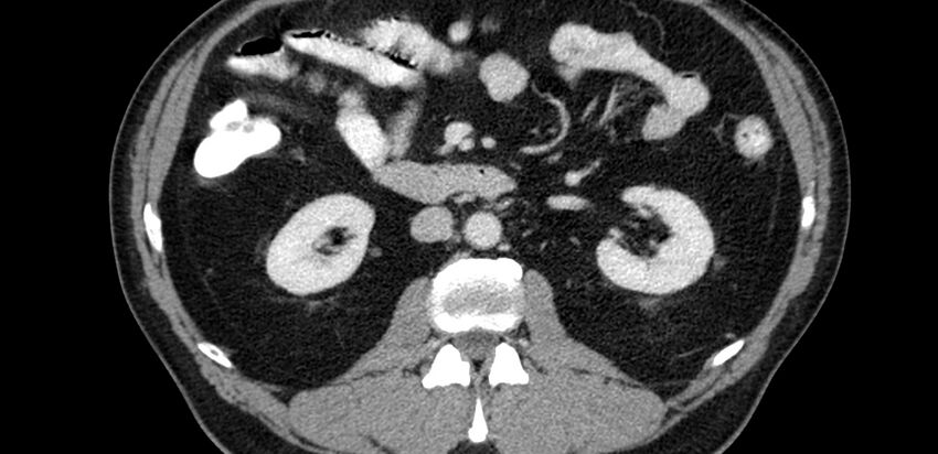 Acute sigmoid colon diverticulitis (Radiopaedia 55507-61976 Axial C+ portal venous phase 1).jpg