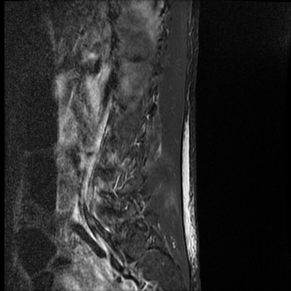 File:Acute vertebral body compression fractures (Radiopaedia 31757-32694 Sagittal STIR 15).jpg