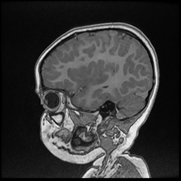 File:Adamantinomatous craniopharyngioma (Radiopaedia 77407-89529 Sagittal T1 C+ 35).jpg