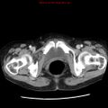 Adenocarcinoma of the colon (Radiopaedia 8191-9039 Axial liver window 74).jpg