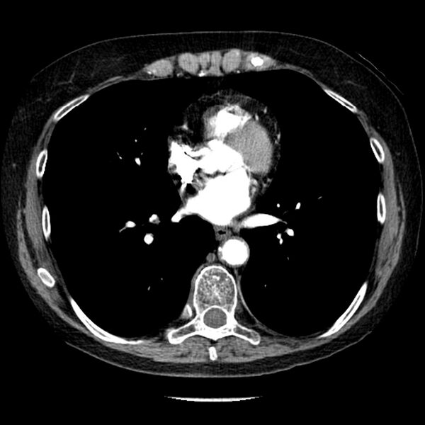 File:Adenocarcinoma of the lung (Radiopaedia 41015-43755 Axial C+ portal venous phase 73).jpg