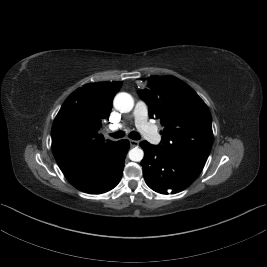 Adenocarcinoma of the lung (Radiopaedia 44205-47803 Axial C+ portal venous phase 36).jpg