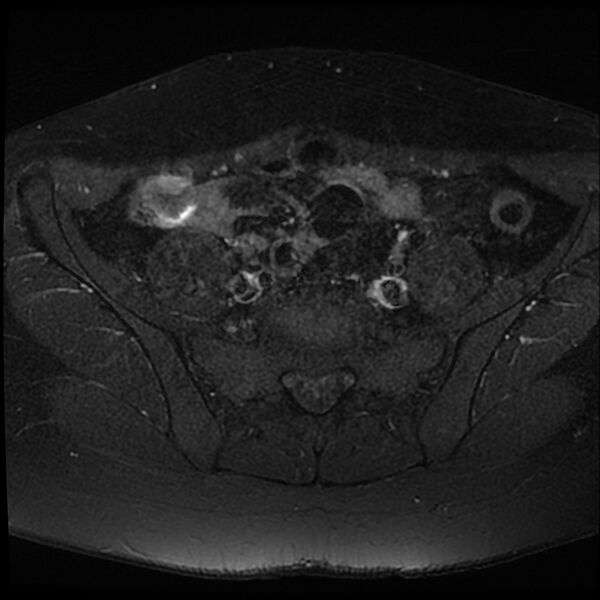 File:Adenomyosis-scar endometriosis (Radiopaedia 65863-75022 Axial T1 C+ fat sat 1).jpg