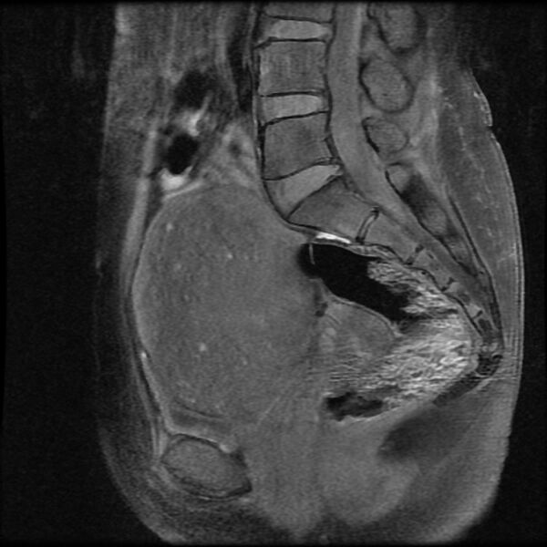 File:Adenomyosis on MRI (Radiopaedia 29328-29780 Sagittal T1 fat sat 8).jpg