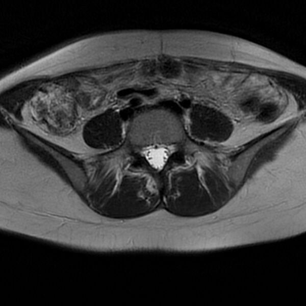 File:Adenomyosis within a septate uterus (Radiopaedia 69963-79981 Axial T2 6).jpg