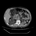 Adrenal myelolipoma (Radiopaedia 41843-44834 Axial non-contrast 27).jpg