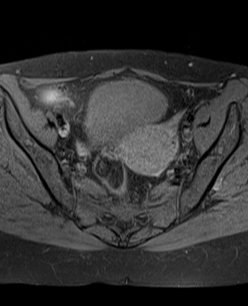 File:Adult granulosa cell tumor of the ovary (Radiopaedia 71581-81950 Axial T1 fat sat 13).jpg