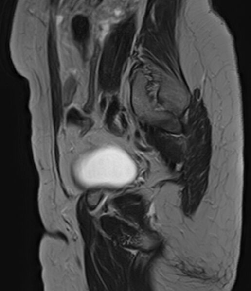 File:Adult granulosa cell tumor of the ovary (Radiopaedia 71581-81950 Sagittal T2 5).jpg