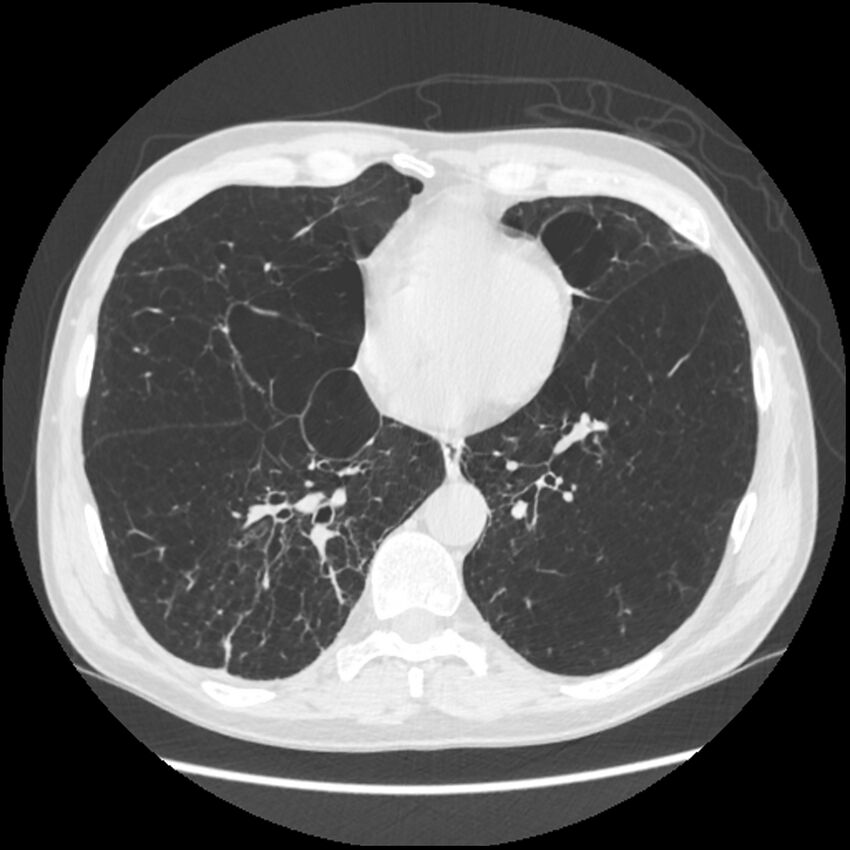 Alpha-1-antitrypsin deficiency (Radiopaedia 40993-43722 Axial lung window 158).jpg