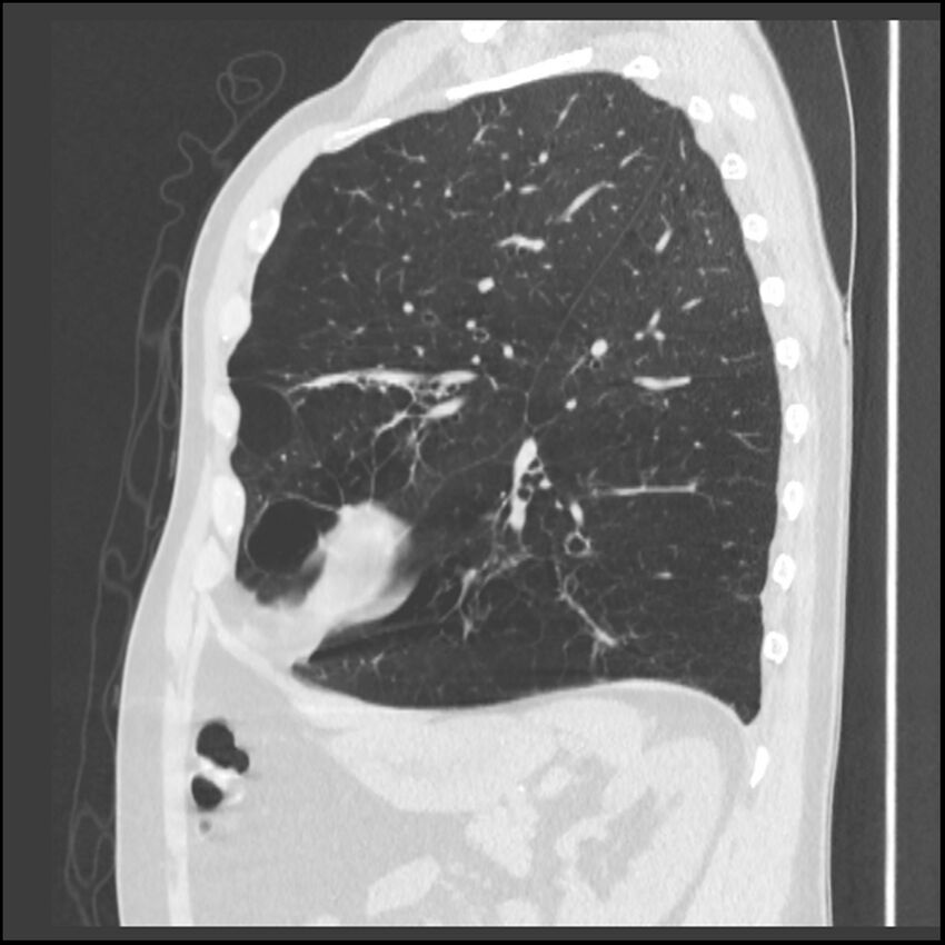 Alpha-1-antitrypsin deficiency (Radiopaedia 40993-43722 Sagittal lung window 82).jpg
