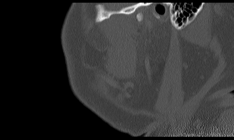 File:Ameloblastoma (Radiopaedia 33677-34806 Sagittal bone window 12).png