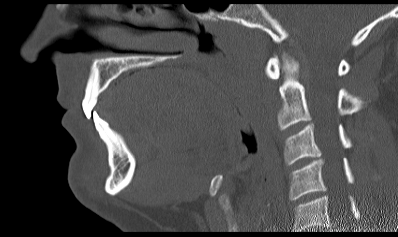 File:Ameloblastoma (Radiopaedia 33677-34806 Sagittal bone window 35).png
