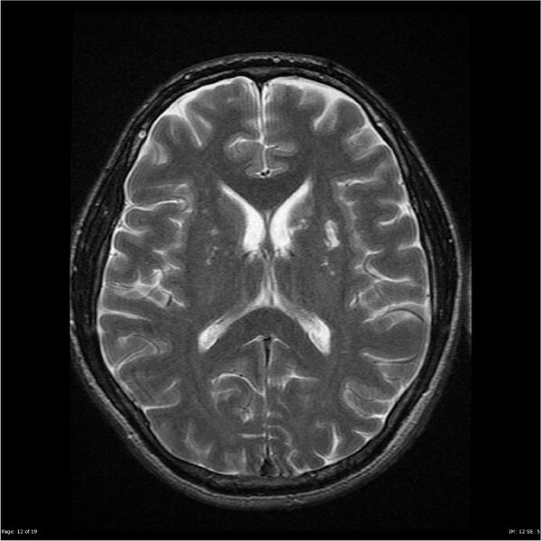 File:Amnestic syndrome secondary to hypoxic brain injury (Radiopaedia 24743-25004 T2 12).jpg