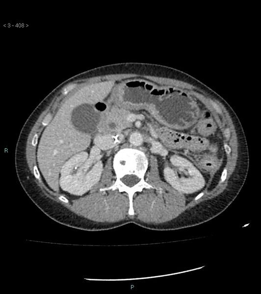 File:Ampulla of Vater metastasis (Radiopaedia 27820-28069 A 46).jpg