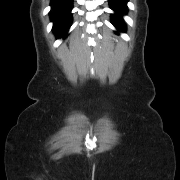 File:Ampullary tumor (Radiopaedia 22787-22816 E 49).jpg