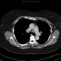 Ampullary tumor and double duct sign (Radiopaedia 24181).jpg