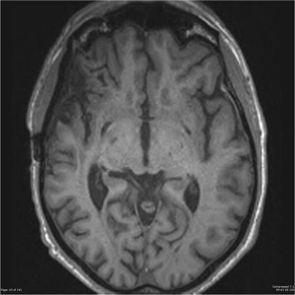 File:Anaplastic meningioma with recurrence (Radiopaedia 34452-35788 Axial T1 61).jpg