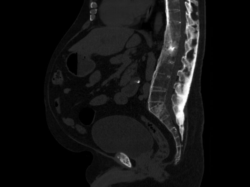File:Ankylosing spondylitis (Radiopaedia 44609-48357 Sagittal bone window 55).jpg