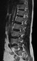 Ankylosing spondylitis - Andersson lesion (Radiopaedia 81878-95838 Sagittal T2 4).jpg