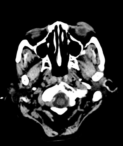 File:Anomalous intracranial venous drainage (Radiopaedia 28161-28418 Axial 62).png