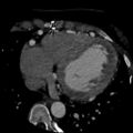 Anomalous left coronary artery from the pulmonary artery (ALCAPA) (Radiopaedia 40884-43586 A 57).jpg