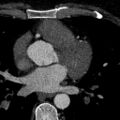 Anomalous origin of the left coronary artery with malignant course (Radiopaedia 77842-90126 C 81).jpeg