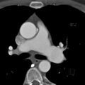 Anomalous right coronary artery (ARCA) with interarterial course (Radiopaedia 12423-12677 B 15).jpg