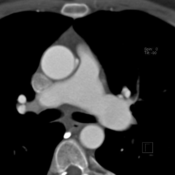 File:Anomalous right coronary artery (ARCA) with interarterial course (Radiopaedia 12423-12677 B 15).jpg