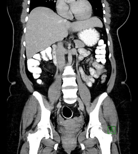 File:Anterior abdominal wall CSF pseudocyst (CSFoma) (Radiopaedia 79453-92571 B 31).jpg