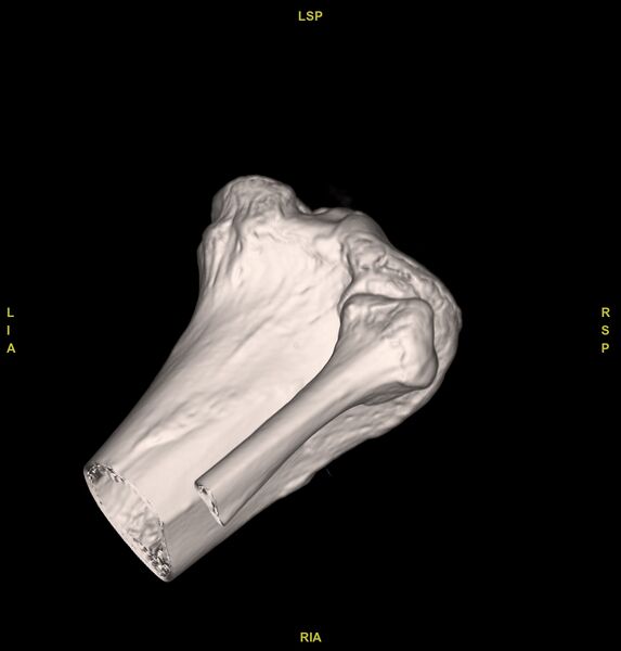 File:Anterior cruciate ligament avulsion fracture (Radiopaedia 58939-66194 VRT 10).jpg