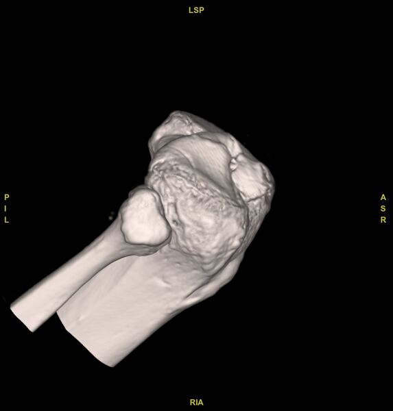 File:Anterior cruciate ligament avulsion fracture (Radiopaedia 58939-66194 VRT 4).jpg