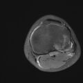 Anterior cruciate ligament tear - pediatric (Radiopaedia 62152-70260 Axial PD fat sat 29).jpg