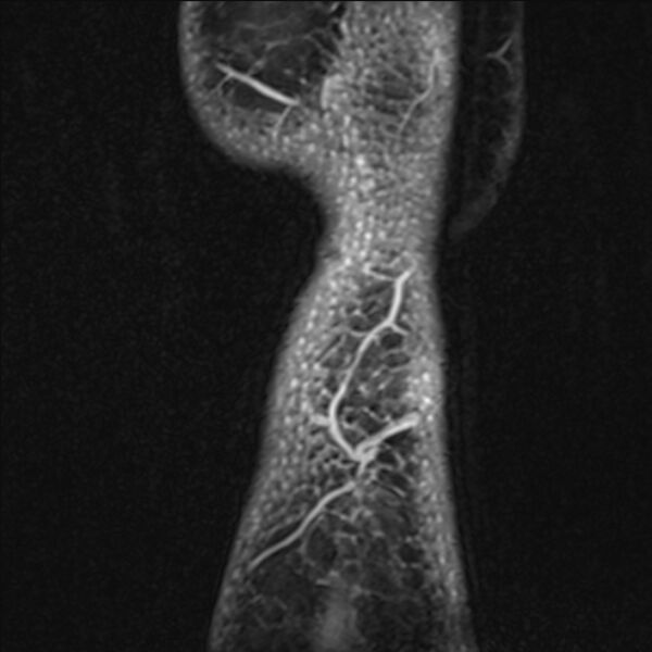 File:Anterior cruciate ligament tear - ramp lesion (Radiopaedia 71883-82322 Sagittal T1 vibe 3).jpg