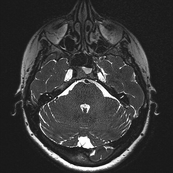 File:Anterior temporal encephalocele (Radiopaedia 82624-96808 Axial T2 high res 32).jpg