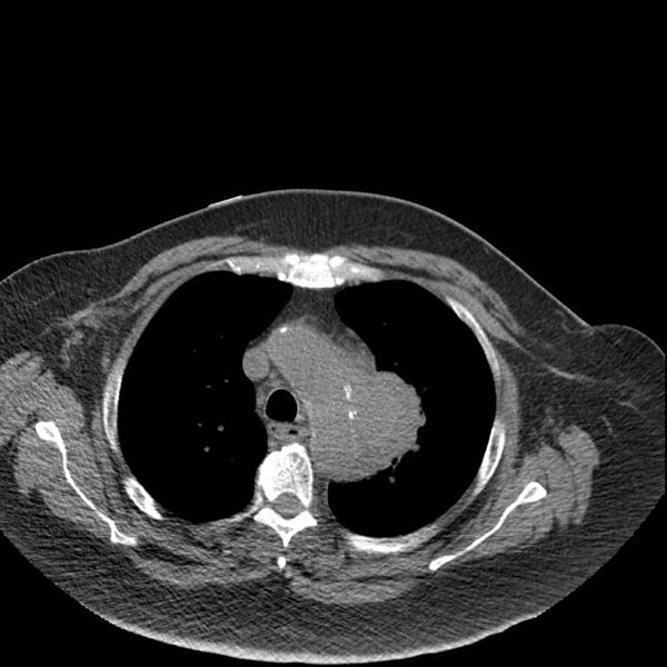 File:Aortic arch false aneurysm (Radiopaedia 14667-14587 Axial non-contrast 10).jpg