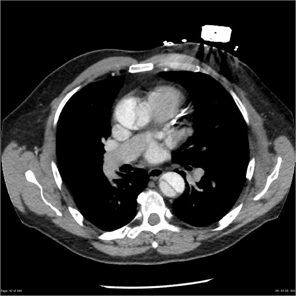 File:Aortic dissection- Stanford A (Radiopaedia 37759-39664 A 33).jpg